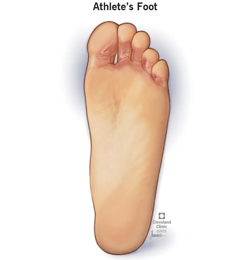 athlete-s-foot-or-toenail-fungal-infection-symptoms-treatment-the